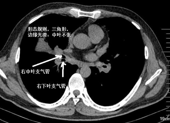 肺不张ct读片太难看完这篇文章轻松入门