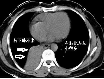 肺不张ct读片太难看完这篇文章轻松入门