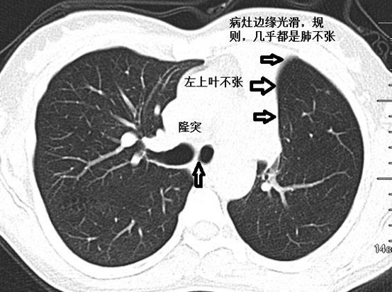 肺不张ct读片太难看完这篇文章轻松入门