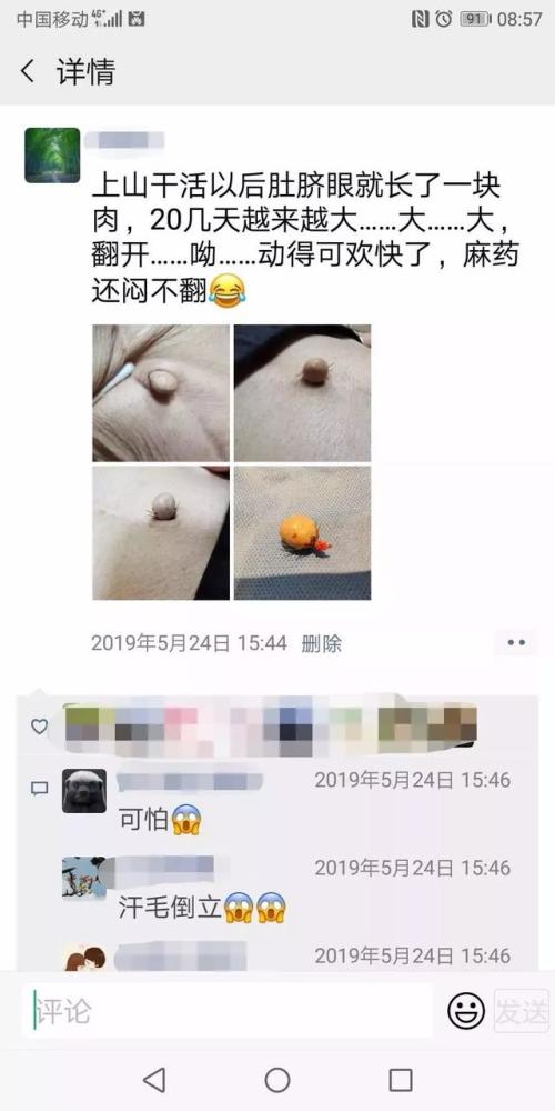 肚脐眼竟长"肉球",还越来越大,这东西被取出时还咬着肉