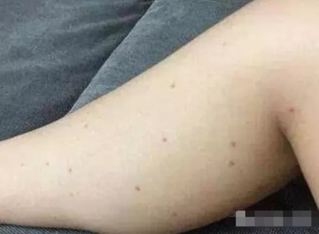 肺癌离你仅"一步之遥"?身体3处出现"小红点",尽早去