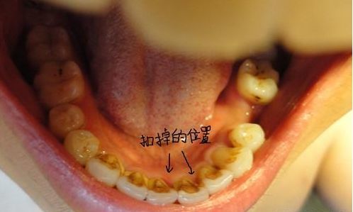 牙齿内侧总有黄色抠不掉的东西,怎么办?