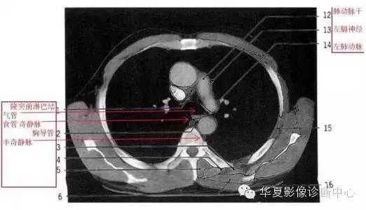 肺动脉窗层面主动脉弓层面主动脉弓上层面胸骨切迹层面纵膈窗右基底支