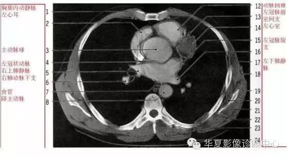 纵隔分区胸部ct影像示意图心室层面左右房室层面左心房层面右肺动脉