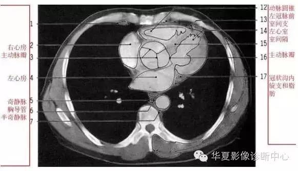 影像解剖▕胸部