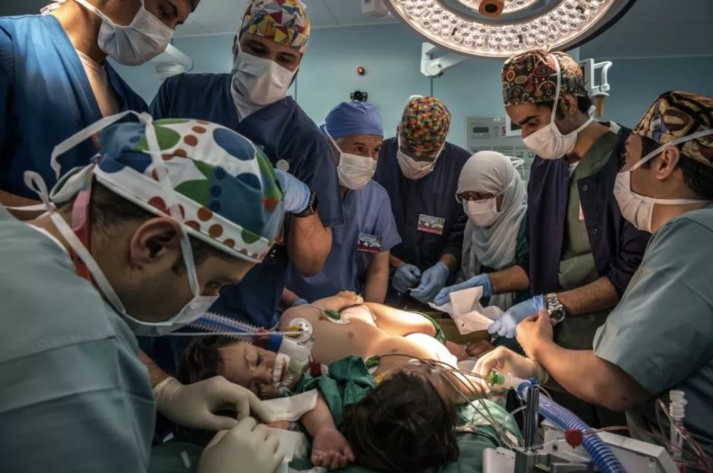 连体婴儿的生死抉择:谁来决定分离手术能否进行?