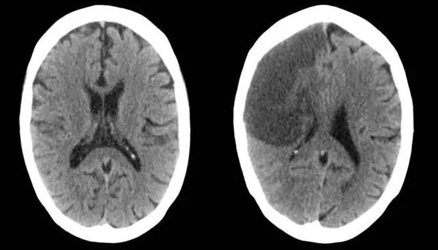 脑实质密度降低征:主要表现为局限性的脑实质(灰质和白质)的密度降低