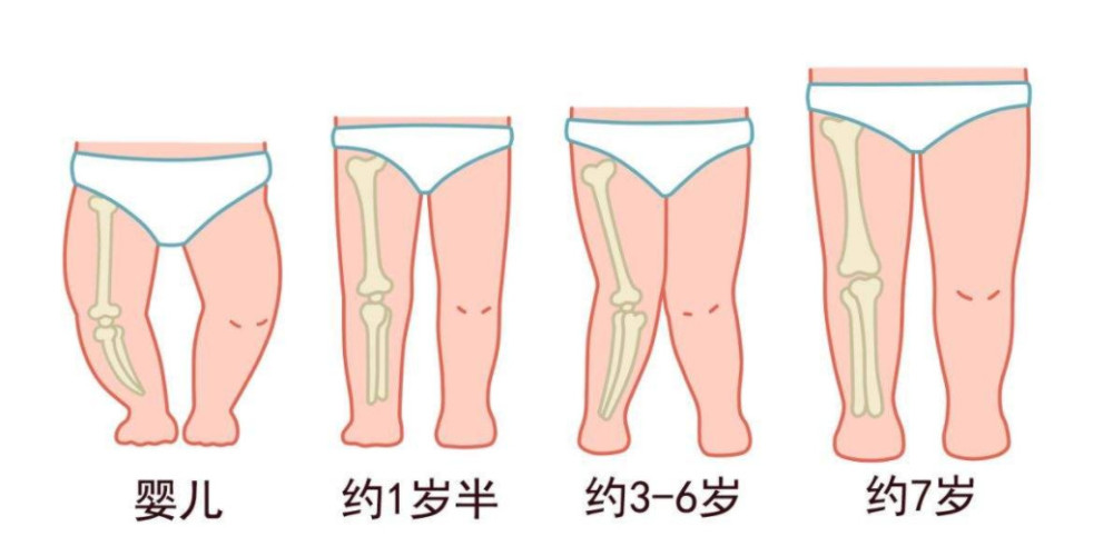 宝宝腿纹不对称很有可能患上这种病妈妈们要注意