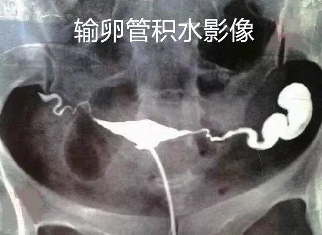 中药保留灌肠治疗输卵管性不孕疗效佳