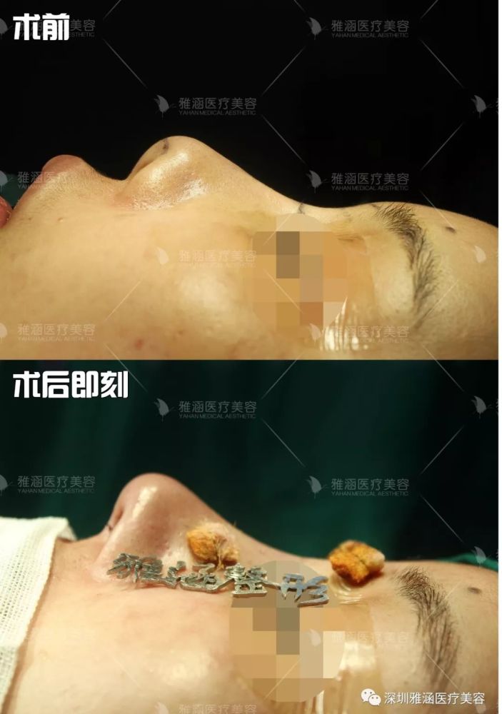 这位小仙女,她之前做过硅胶假体隆鼻,已有8年了.