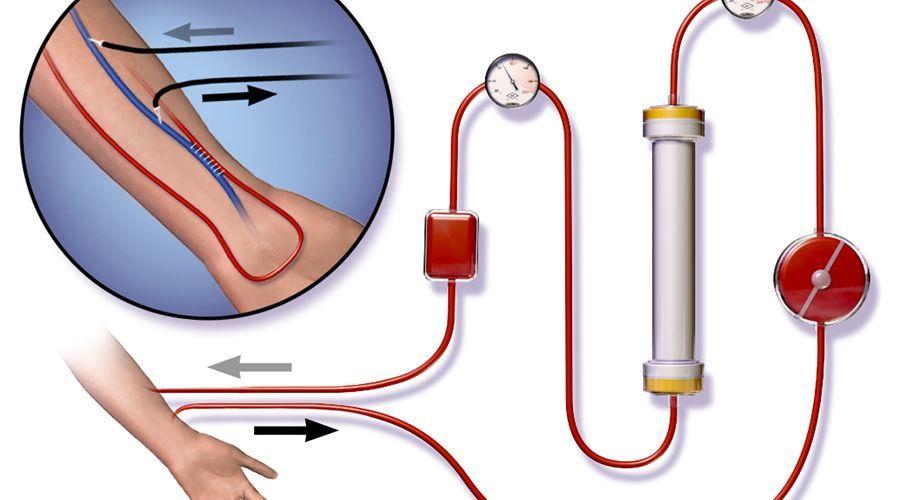 (血液透析原理图)