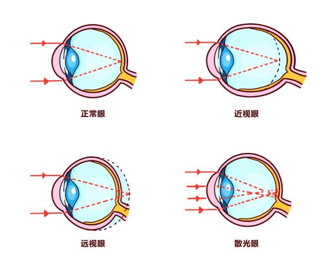 2岁女童近视900度!这样做,让孩子远离近视