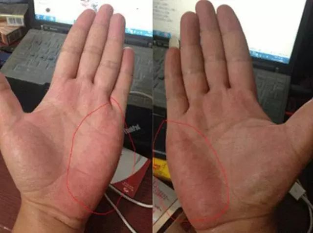 是肝病患者最常见的体征,这种手掌发红的表现,在医学上又被叫做"肝掌"