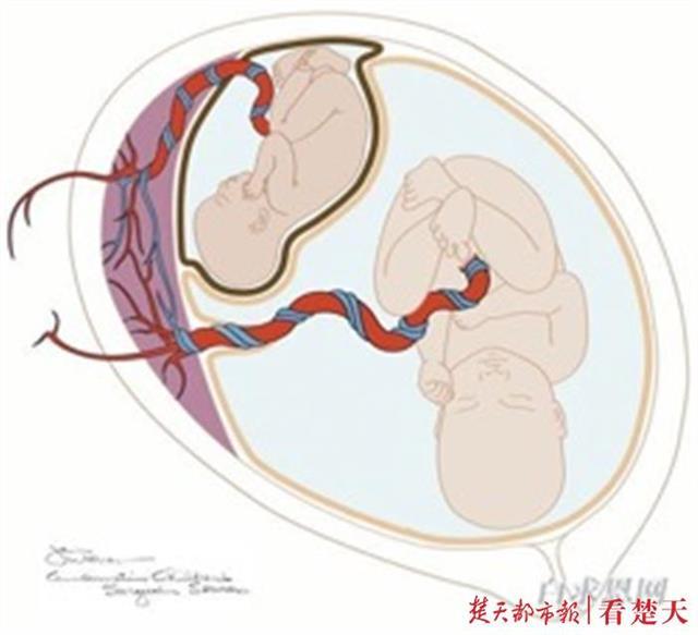 双胎输血综合征子宫内示意图