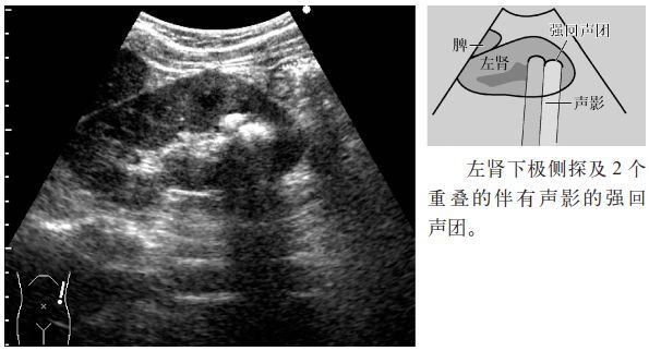 临床必备肾结石输尿管结石超声表现一览