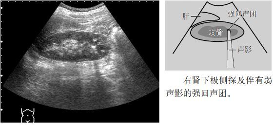 临床必备肾结石输尿管结石超声表现一览