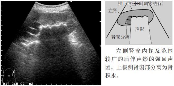 临床必备肾结石输尿管结石超声表现一览