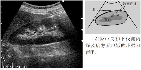 临床必备肾结石输尿管结石超声表现一览