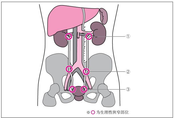 图9输尿管结石好发部位(输尿管生理性狭窄部位)图10 输尿管结石(肾盂