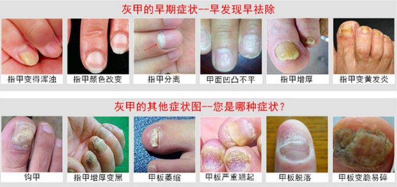 德国科技生物膜,涂抹一下,7天重获亮甲,20年顽固灰指甲也能救.