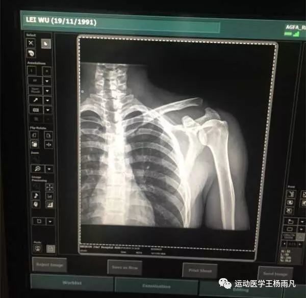 武磊的x光片 锁骨翘起,和肩峰分离