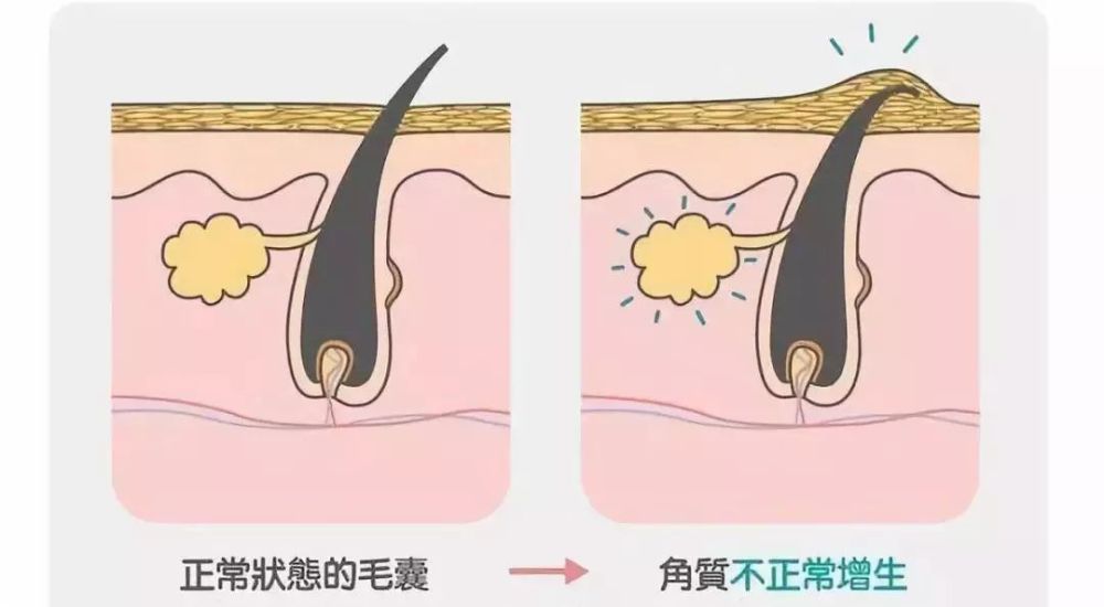 引起鸡皮肤最根本的原因,是因为毛囊周围的角质层变厚,造成毛孔角质