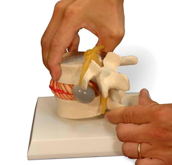 瑜伽蝗虫式可以治疗腰椎间盘突出,为啥你却练