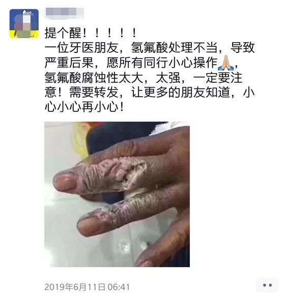 恐怖氢氟酸处理不当他的手指差点废了