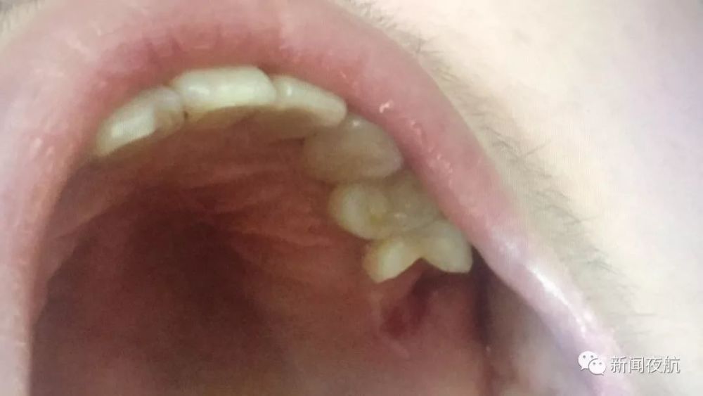 哈尔滨一女子拔完牙惊呆了!