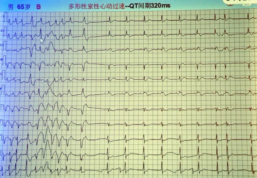 4. 尖端扭转型室性心动过速,多形性室性心动过速,双向性室性心动过速.