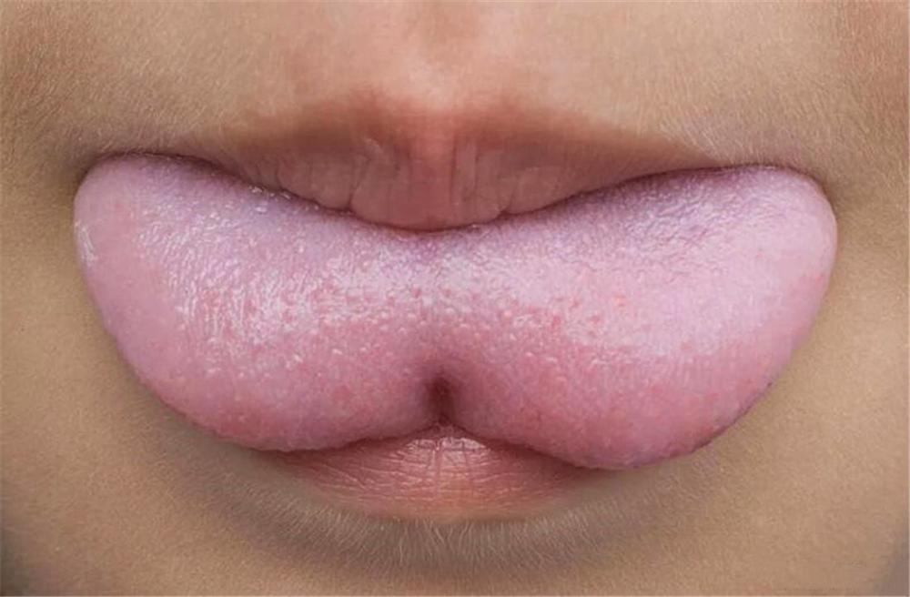 我们正常的舌头前端是一个凸出的弧形,但是如果舌系带过短的话,因为