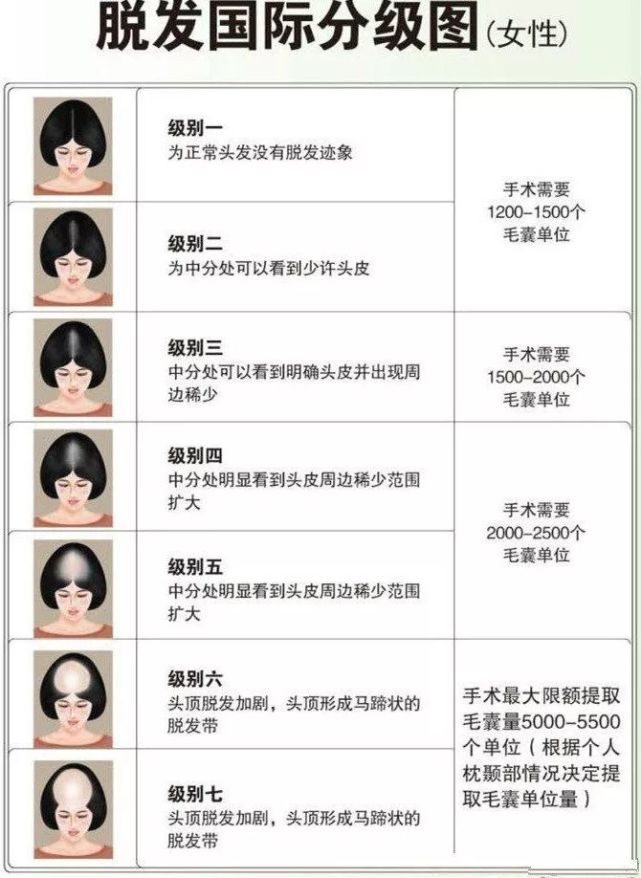 2019女生秃头等级对照表,快看看你"秃"到哪一级了?