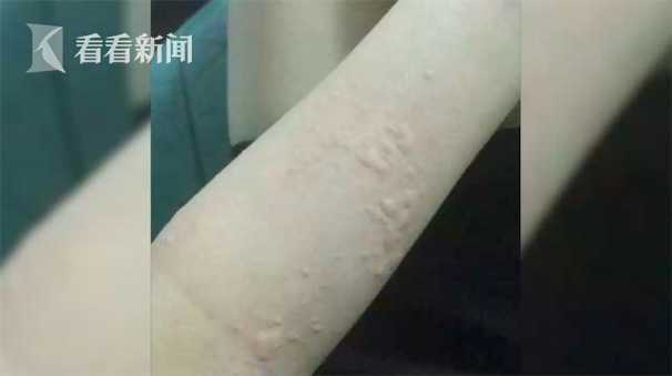 有过敏史还不忌口,准妈妈吃下20只小龙虾 致荨麻疹险