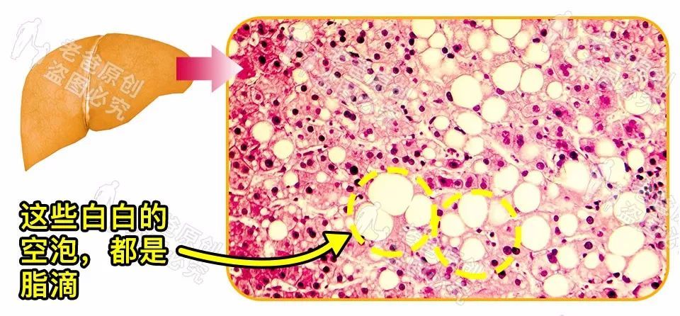 肝细胞脂肪变性