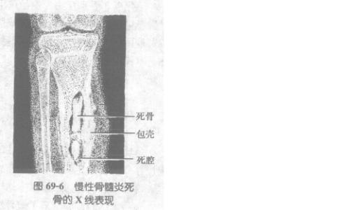 "附骨疽"是何病?乾隆最宠爱的永琪因此而死,满清皇室多患此病