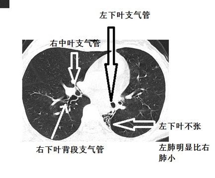 支气管告密:这个肺部ct有问题!