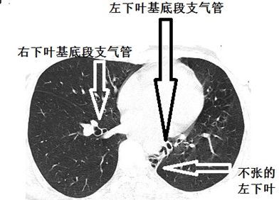 支气管告密:这个肺部ct有问题!