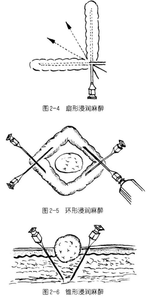 牙医必备的18个临床麻醉图片概览!