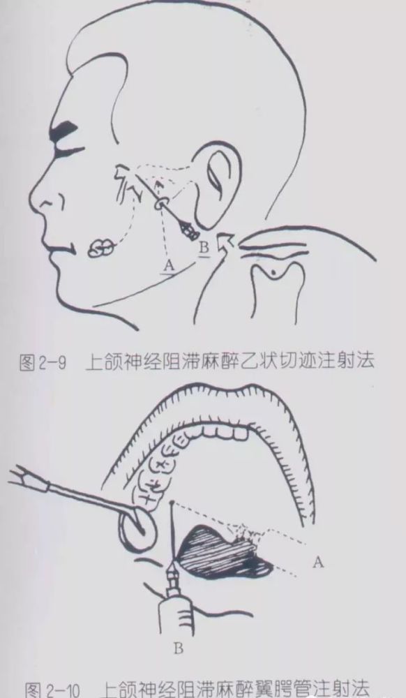 图2—7 唇侧根尖部浸润麻醉图2—2 表面喷射麻醉图2—1