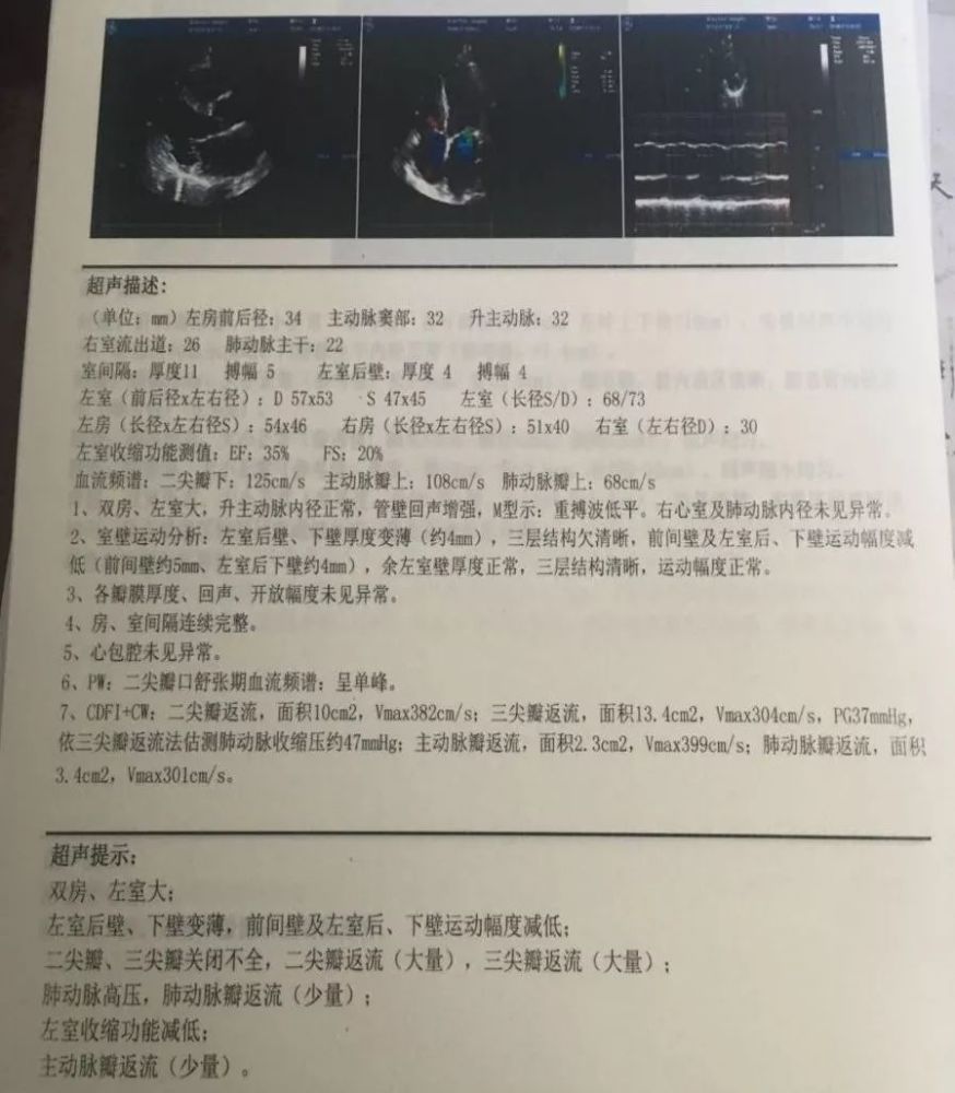 图2. 患者入院超声心动图检查结果