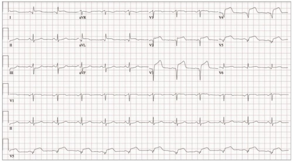 图1:12导联心电图