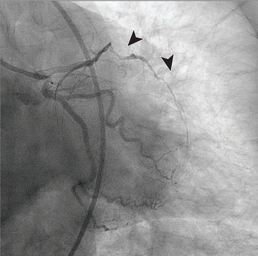 图2:冠脉造影检查结果