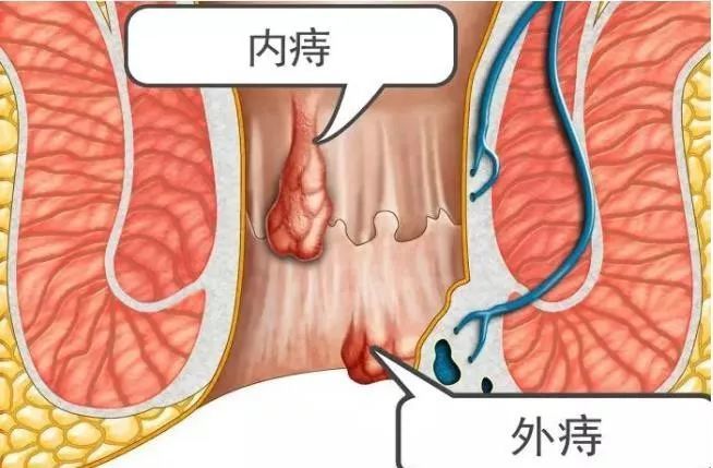 内痔,外痔示意图