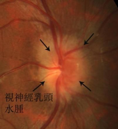 血压病情严重者,动脉变细,出现视乳头水肿,引起视力严重下降,眼底出血
