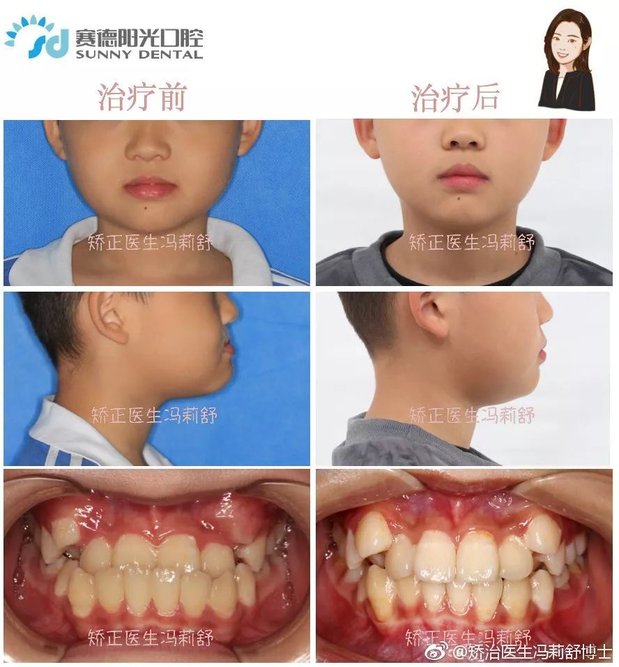 【暑期特惠】为什么要抓住孩子牙齿矫正的黄金期