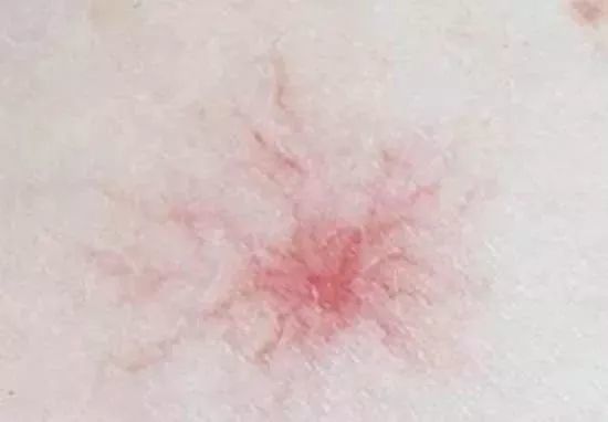 第一处:手上出现蜘蛛痣