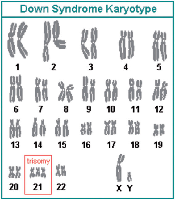 揭开唐氏综合征的神秘面纱