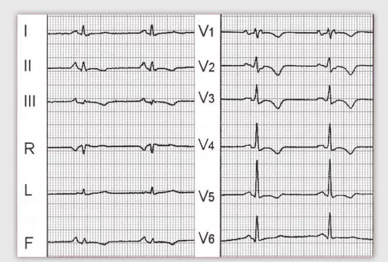 注意:这些特征心电图改变,都是猝死的前兆!