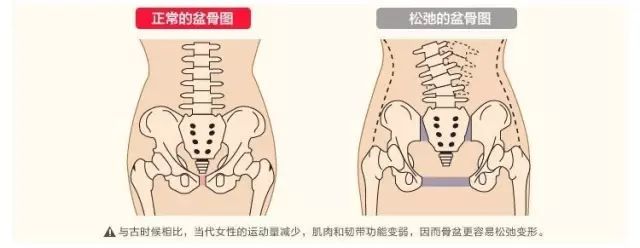 有的妈妈会说,我是剖腹产,没开骨缝,不需要做骨盆修复.