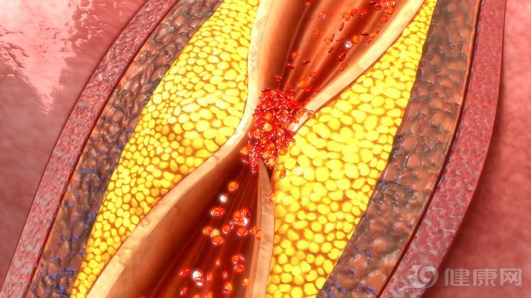 最后,颈动脉血管壁凝结脂类斑块物质就会导致颈动脉粥样硬化,斑块破裂